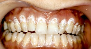 Гиперестезия зубов