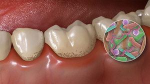 Причины поражения зуба