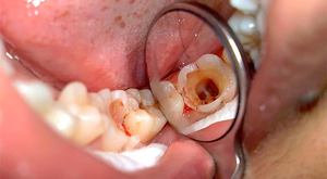 Лечение пульпита у стоматолога