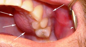 Периостит  - диагностика заболевания зубов