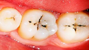 Почему возникает кариес на зубах