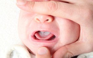 Лечение стоматита у малышей