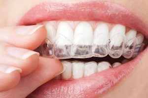 Лечение зубов - стоимость