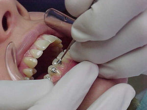 Пломбирование зубного канала пастам