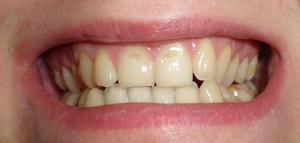 Как лечить эрозию эмали зубов