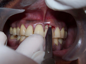 Дренаж абсцесса зуба