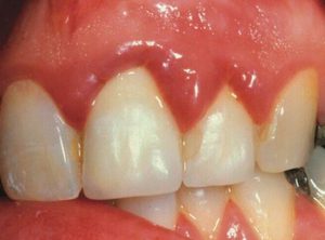 Как проявляется воспаление корня зуба