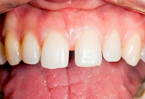 Почему появляется щель между зубами