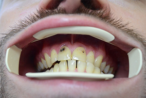  поражение кариесом передних зубов
