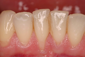 Обнажение корня зуба-причины