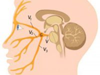 Как протекает воспаление тройничного нерва