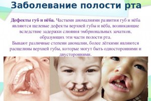 Лечение болезней полости рта