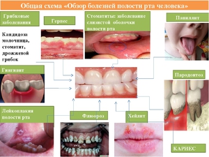 Методы лечения различных заболеваний полости рта