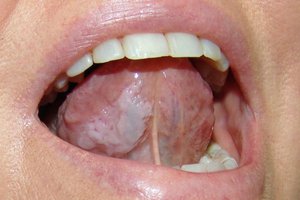 Лейкоплакия — это серьёзная болезнь, которая возникает в полости рта