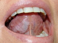 Лейкоплакия — это серьёзная болезнь, которая возникает в полости рта