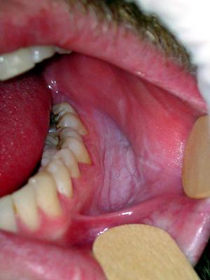 Диагностика лейкоплакии ротовой полости и лейкоплакии языка