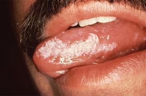 Симптоматика лейкоплакии полости рта 