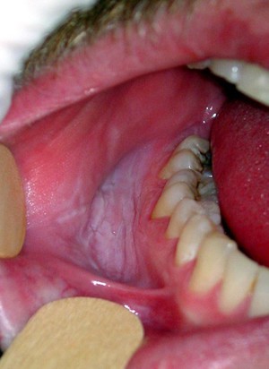 Причины лейкоплакии полости рта