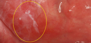 Лейкоплакия слизистой оболочки полости рта