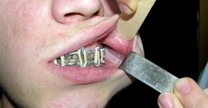 Методика лечения перелома челюсти