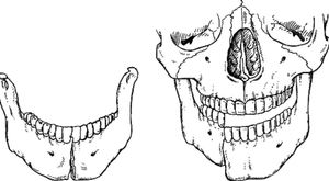 Виды перелома челюсти