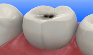 Лечение точек на зубах