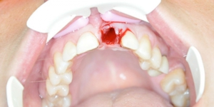 Удаление переднего зуба 