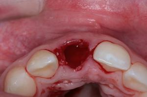 Альвеолит лунки переднего зуба