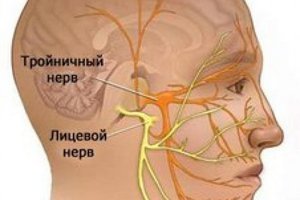 Лечение неврита тройничного нерва