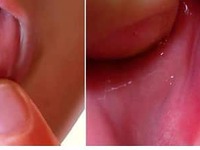 Стоматит на нижней губе