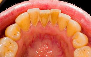 Этапы лечения зубного камня 