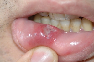 Описание видов воспалений слизистой полости рта