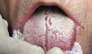 Симптомы кандидоза во рту