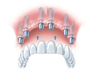 Мосты для зубов на имплантах