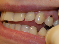Описание заболевания пришеечного кариеса зубов