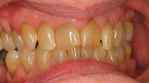 Патогенез пришеечного кариеса зубов