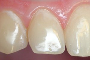 Симптомы пришеечного кариеса зубов