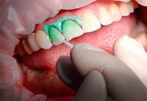 Особенности и методы лечения пришеечного кариеса зубов