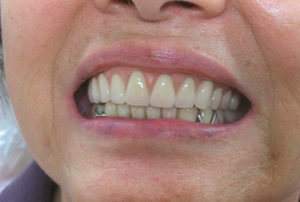 Вид съемных зубных протезов