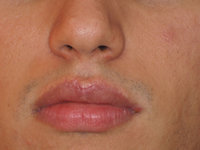Как лечить гранулы фордайса на губах