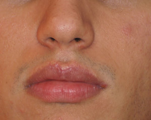 Как лечить гранулы фордайса на губах