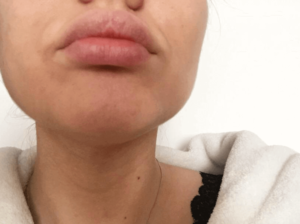 Почему появились гранулы фордайса на губах
