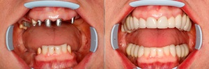 Когда показано имплантирование зубов