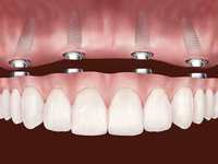 Импланты и протезирования зубов