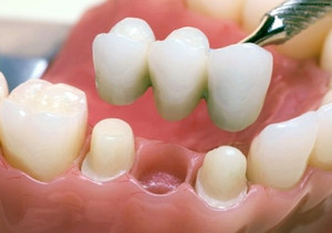 Несъемные несъемные зубные протезы  