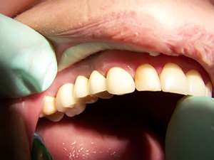 Несъемное  протезирование -зубные протезы 