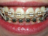 Опасная тенденция разрушает зубы