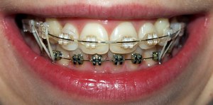 Опасная тенденция разрушает зубы