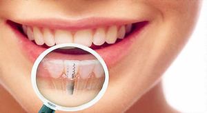 Имплантация зубов-показания