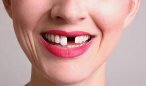 Показания к имплантации-отсутствие зуба